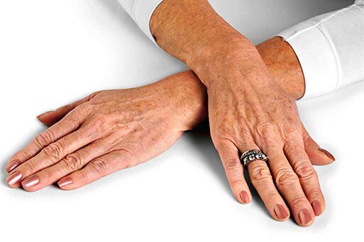 Pielea mâinilor cu modificări legate de vârstă care necesită utilizarea tehnicilor de întinerire