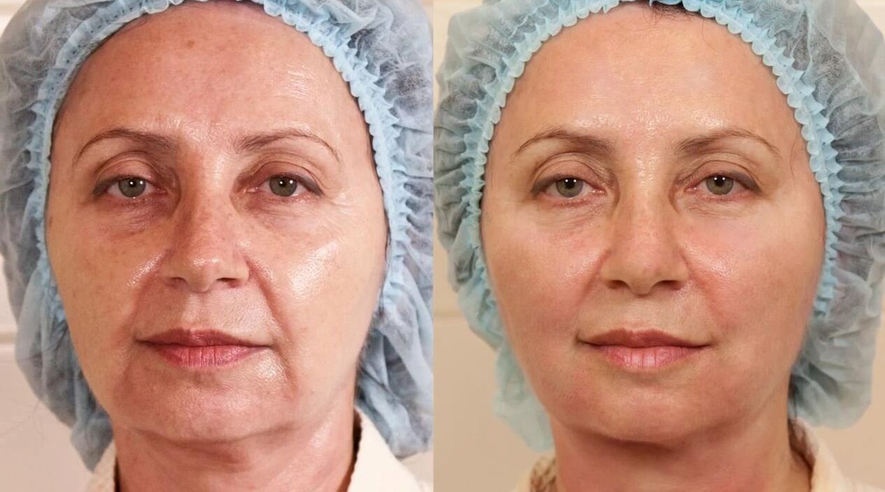 fotografii înainte și după lifting facial