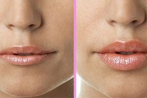 înainte și după procedura de refacere a buzelor